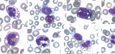 Vacuolisation des leucocytes dans le syndrome de dorfman-chanarin